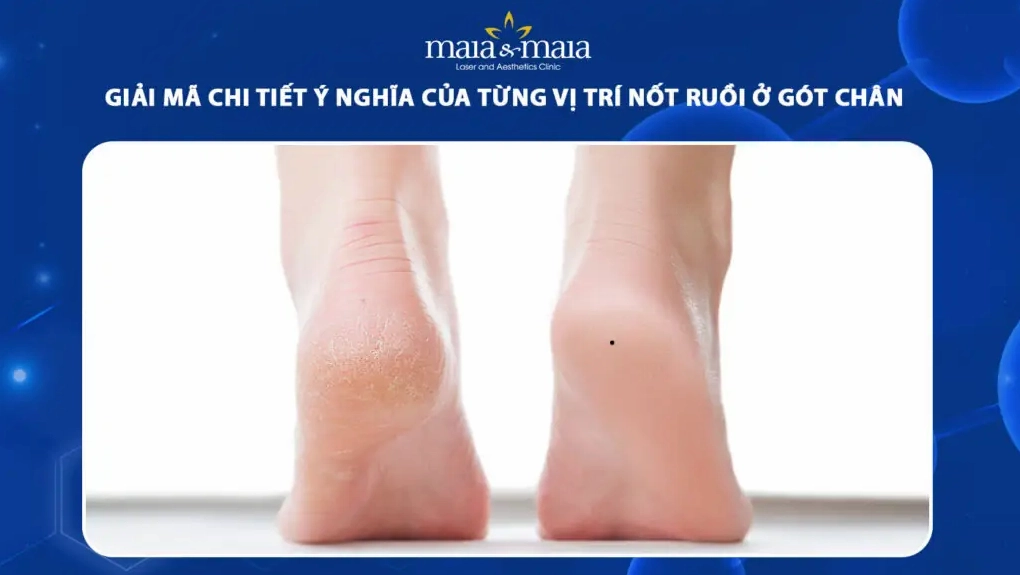 ận cảnh một nốt ruồi ở gót chân và ý nghĩa phong thủy