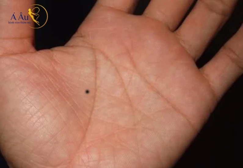 Có nên xóa nốt ruồi ở lòng bàn tay hay không ?