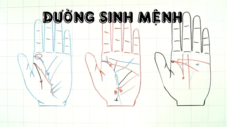 Đường chỉ tay sinh mệnh có thể bị ảnh hưởng bởi yếu tố di truyền