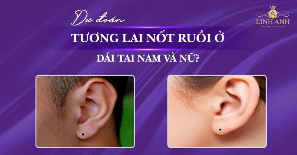 Hình ảnh nốt ruồi ở dái tai mang ý nghĩa phúc tướng