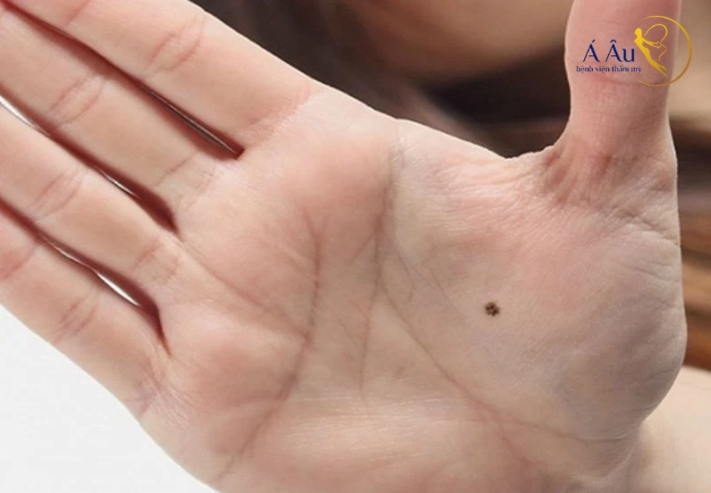 Nốt ruồi ở lòng bàn tay phải