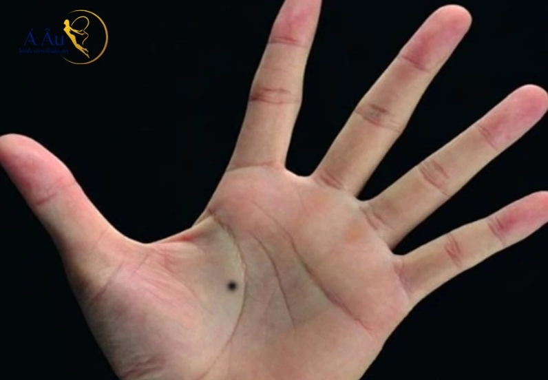 Nốt ruồi ở lòng bàn tay trái